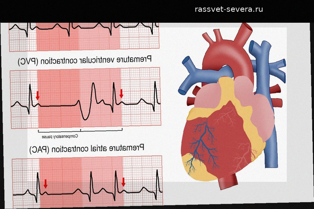 В Испании зафиксирован самый высокий рост внезапной смертности в Европе: +3,3% ежегодно за десятилетие